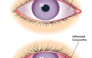 pink eye symptoms